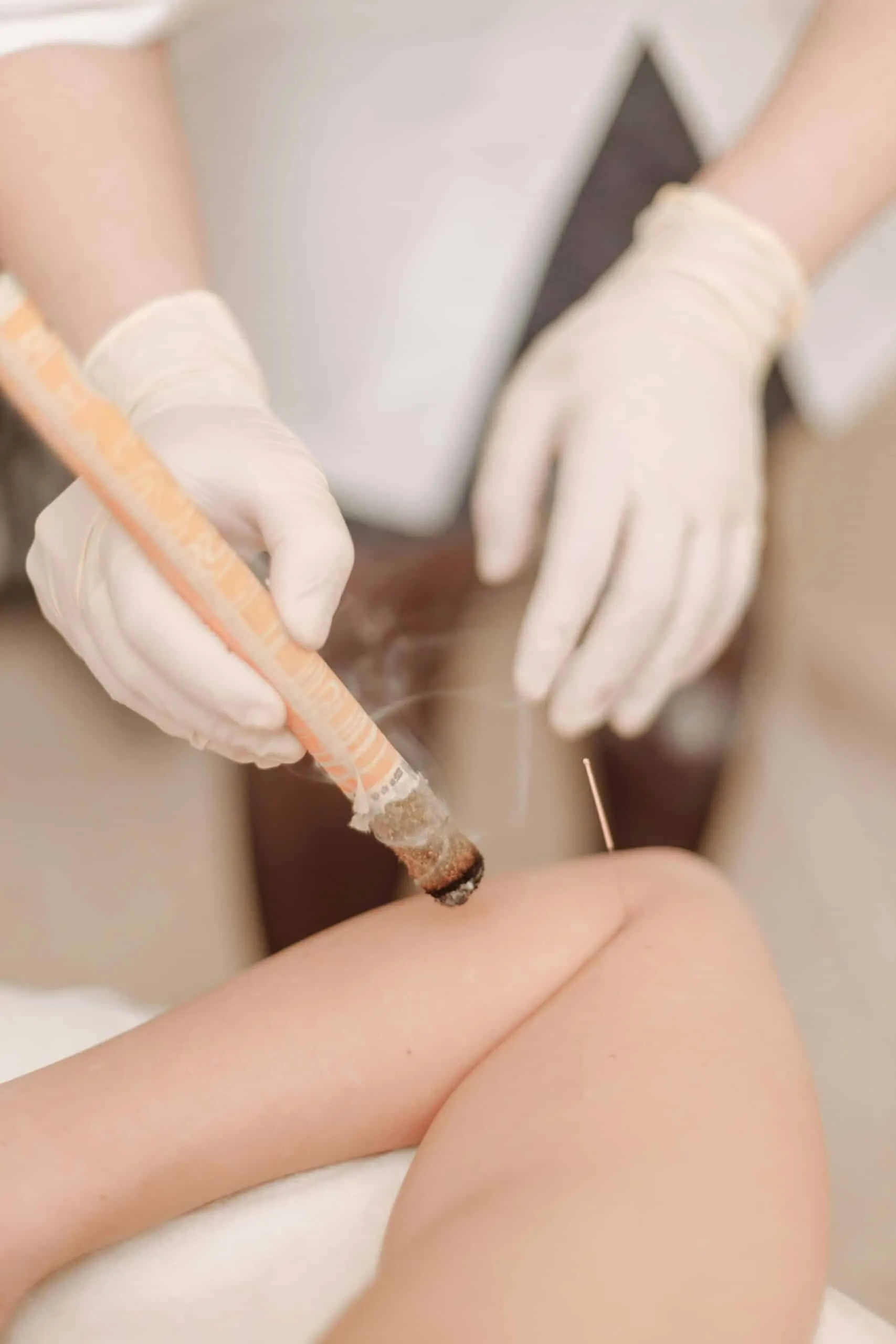 Praticienne tenant un bâton de moxibustion près d’une jambe, avec une aiguille visible
